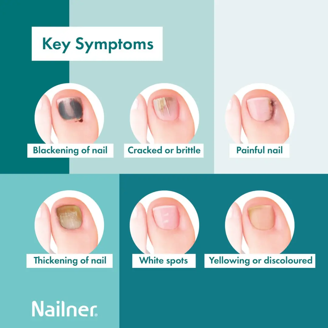 Nailner Kalknagelkwastje 5ml