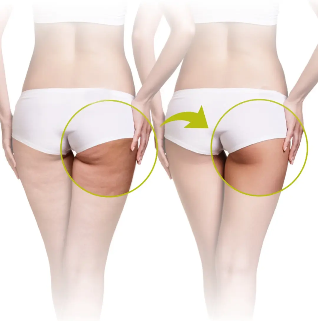Lanaform Skin Mass Grey Cellulite Apparaat - Vibratie Rollers - 9V - afbeelding 5 van 6
