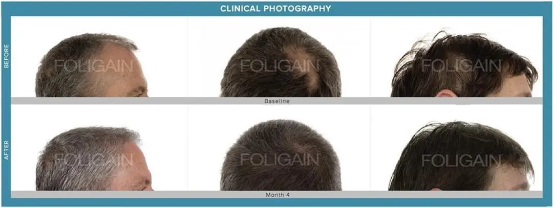 Foligain Anti-Haaruitval Set - 531ml (3 stuks)