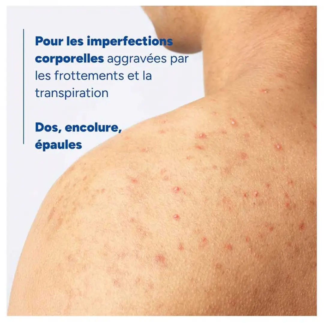 Ducray Keracnyl Anti-acne-spray Lichaam 150ml