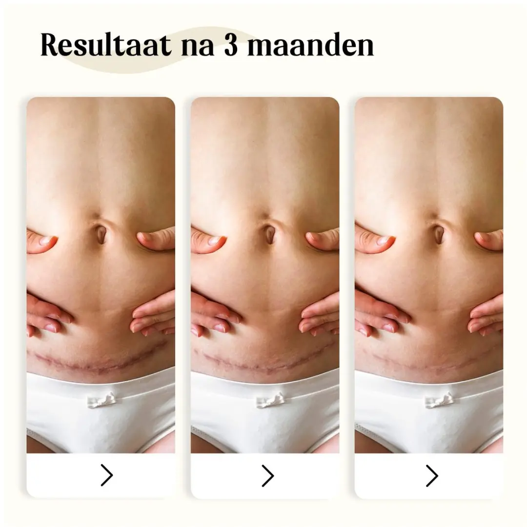 Dermatix Siliconengel Bodygel 15g - afbeelding 6 van 6
