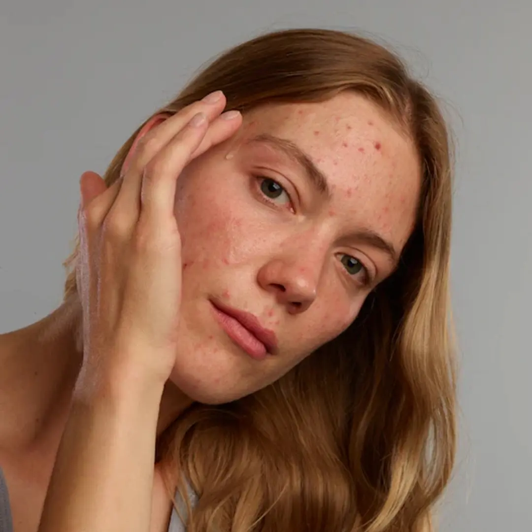 Gladskin Acnefekt Gel 30ml - Microbioomvriendelijk