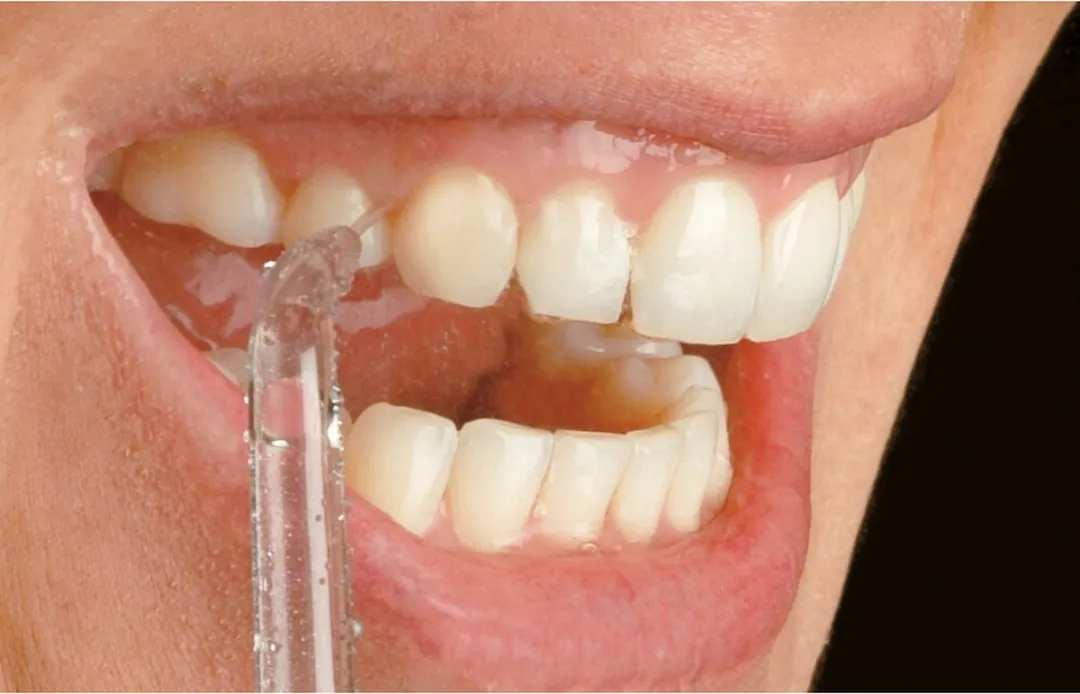 Waterpik JT-100 Jet Tips - 2 Stuks - Zilver - afbeelding 6 van 6
