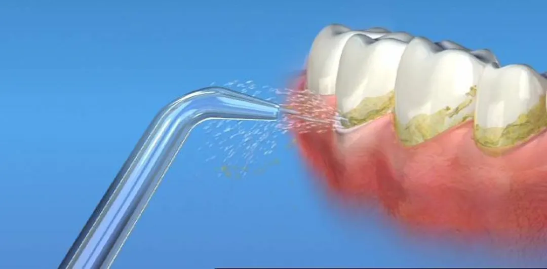 Waterpik JT-100 Jet Tips - 2 Stuks - Zilver