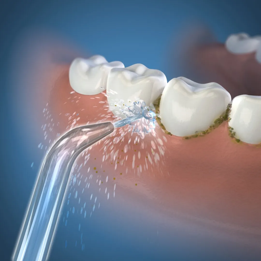 Waterpik JT-100 Jet Tips - 2 Stuks - Zilver