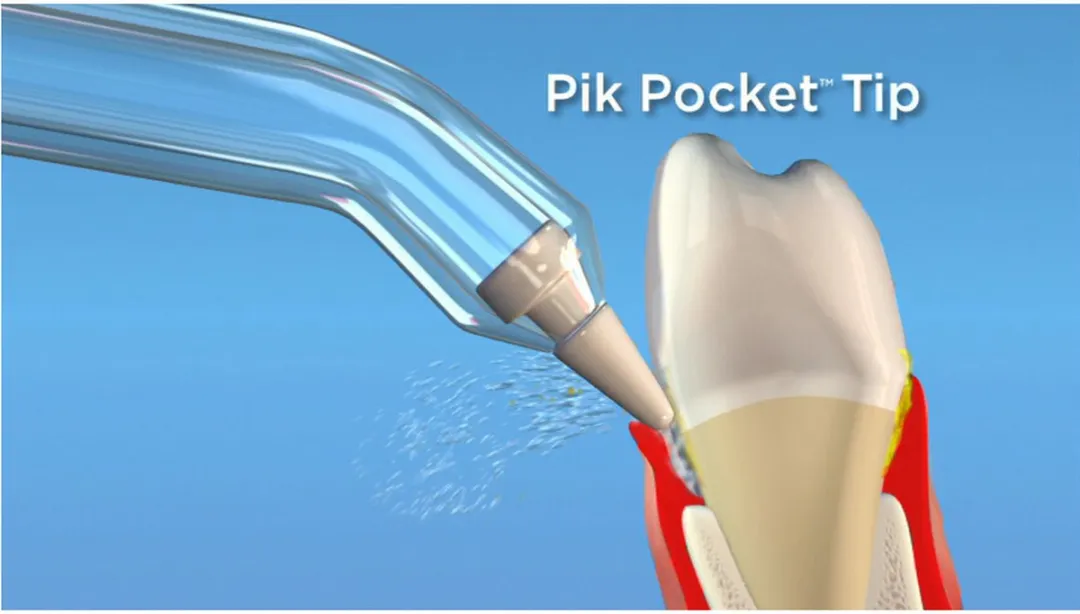 Waterpik PP-70 Pik-Pocket Tips - 2 Stuks