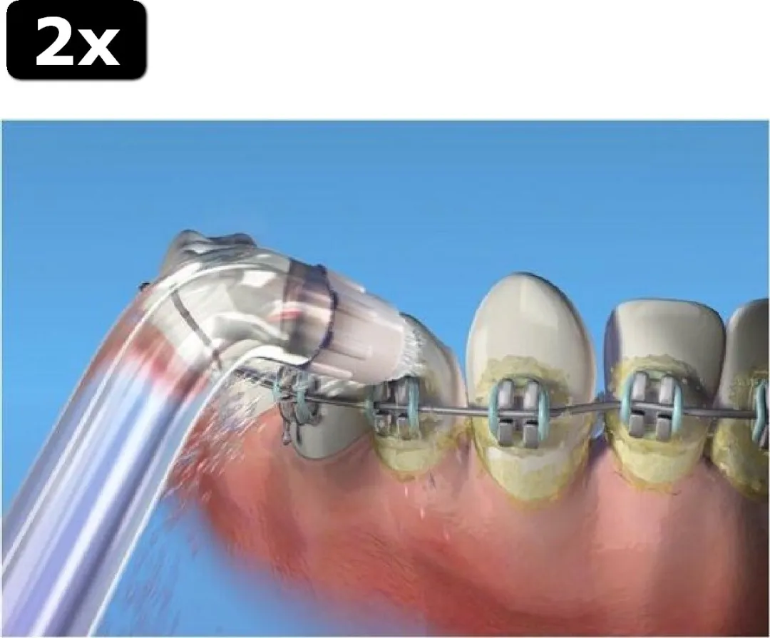 Waterpik OD-100 Orthodontische Tips - 2 Stuks
