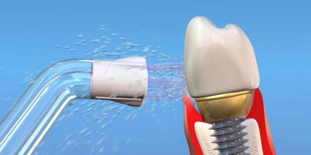 Waterpik PS-100E Plaque Seeker Tips - Opzetstukken Voor Waterflossers - 2 Stuks - zilver