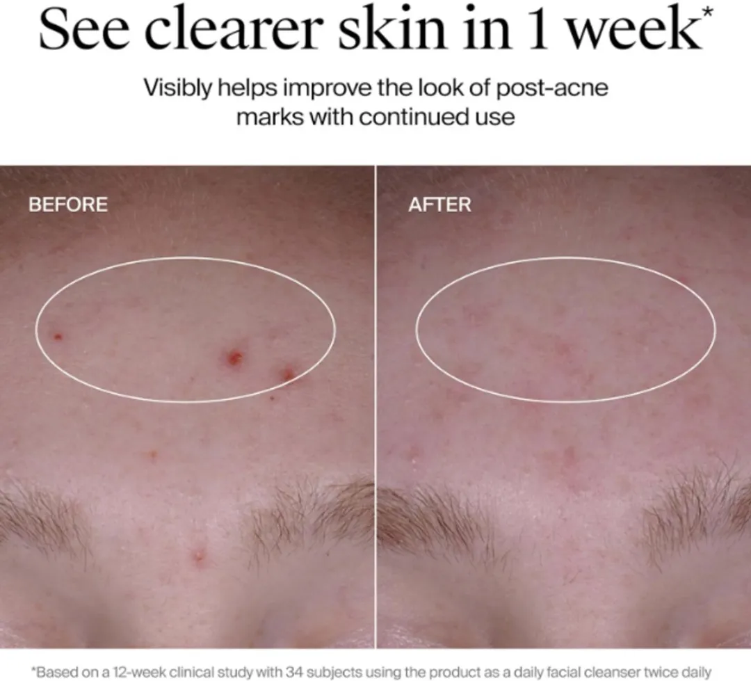 Neutrogena Evenly Clear Acne Cleanser 269ml - Schuimende Gezichtsreiniger