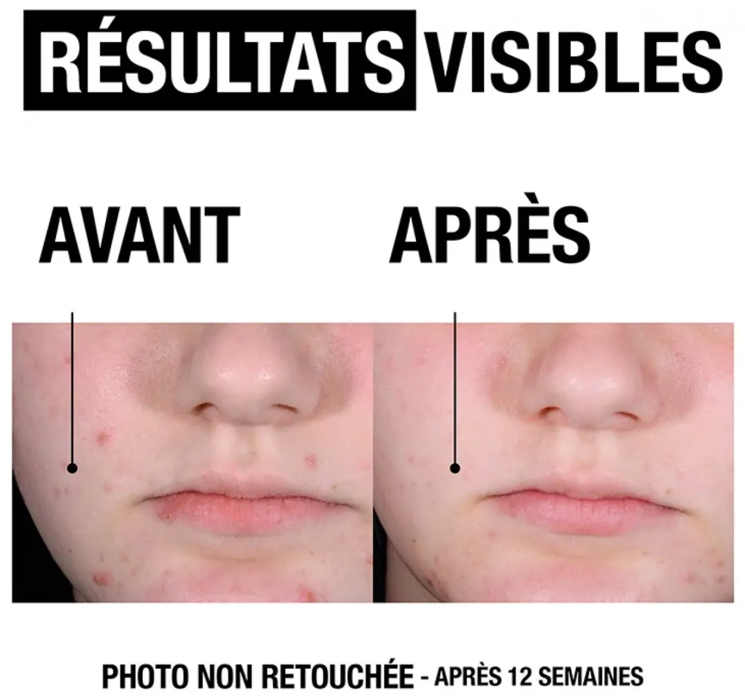 Neutrogena Anti-Blemish Geurvrije Hydraterende Gel 50ml