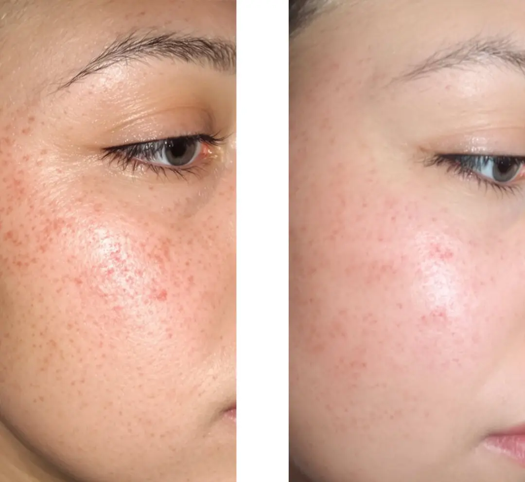 Australian Bodycare Salicylzuur 2% Serum 30ml