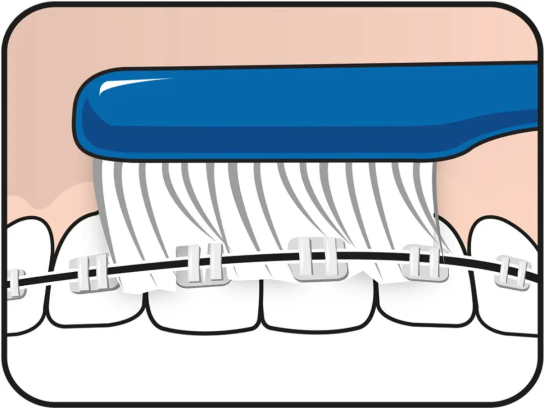 TePe Implantaat & Orthodontieborstel Blauw - 3 Stuks