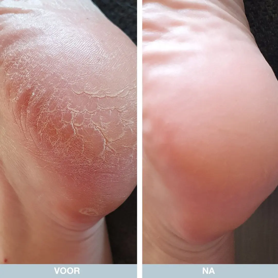 Australian Bodycare Voetcrème Droge Voeten 2x100ml - Ureum & Tea Tree