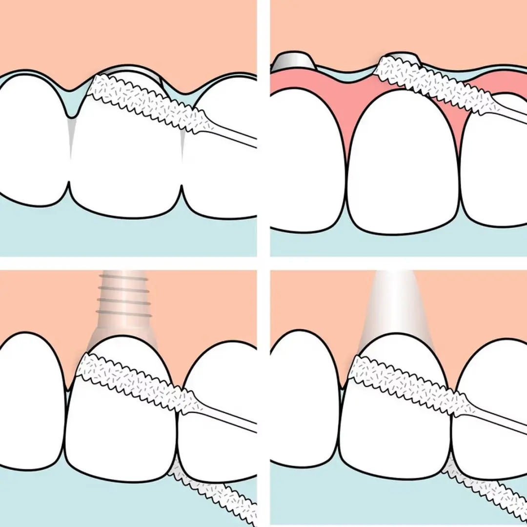 TePe Bridge & Implant Floss 30 Stuks - afbeelding 6 van 6