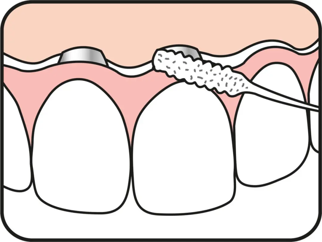 TePe Bridge & Implant Floss 30 Stuks - 5x4