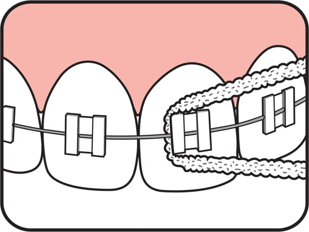 TePe Bridge & Implant Floss 30 Stuks - 5x4