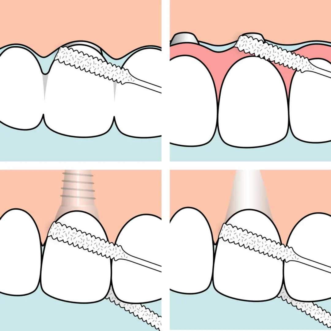 TePe Bridge & Implant Floss - 30 Stuks - afbeelding 6 van 6