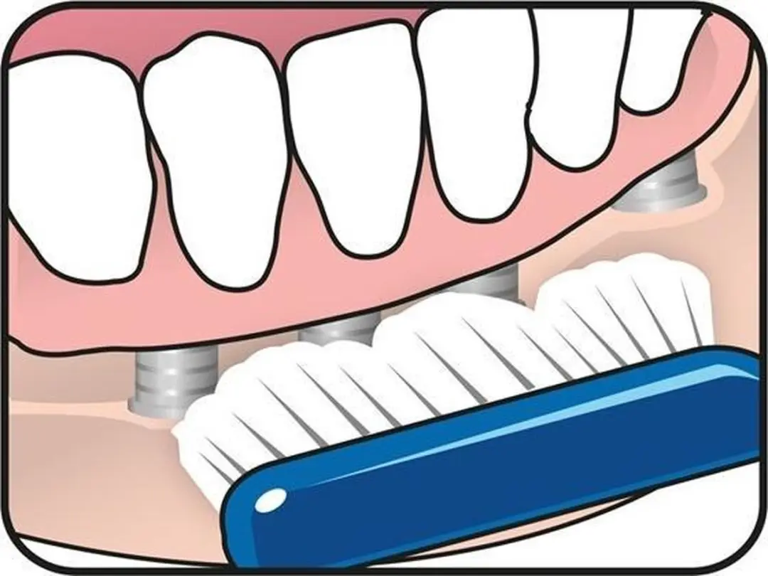 TePe Implantaat/Orthodontieborstel - 3 Stuks