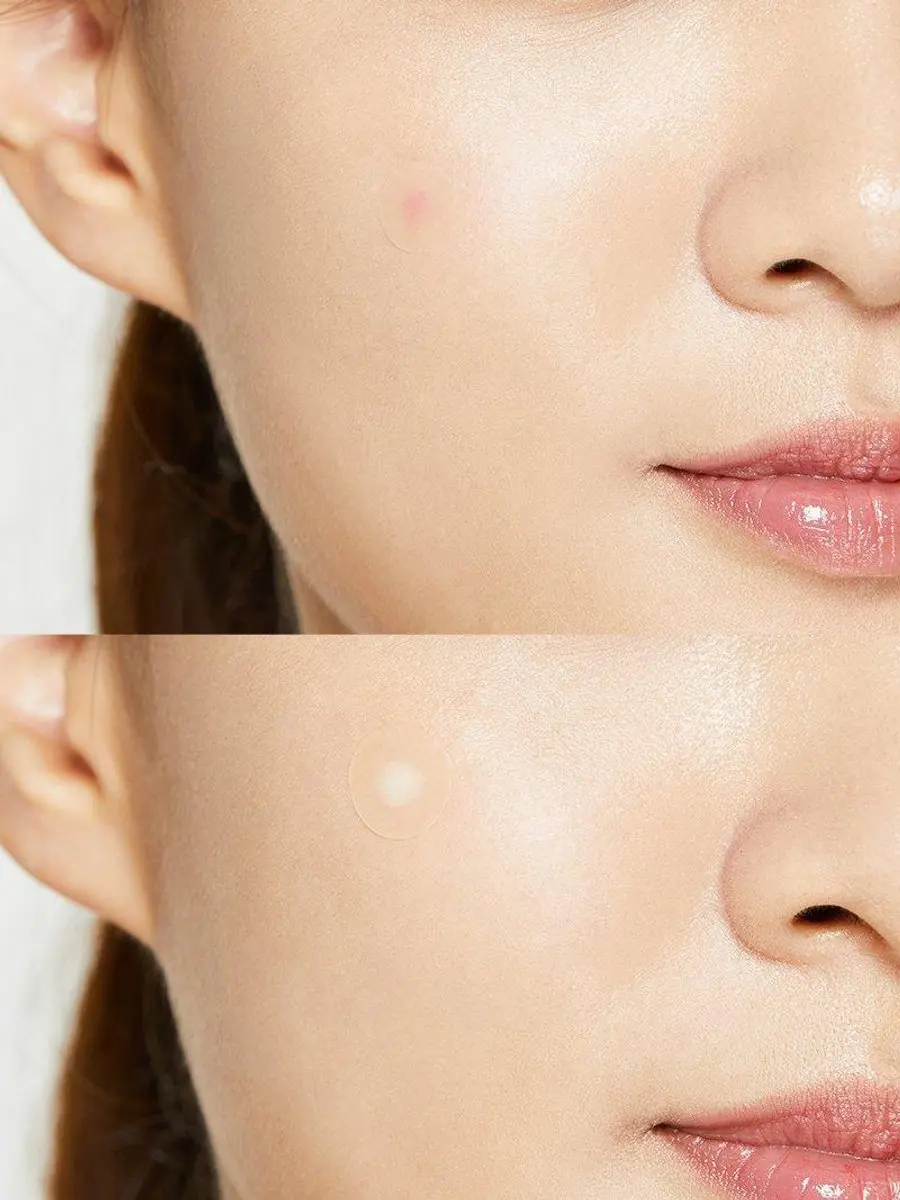 CosRx Acne Pimple Master 7g