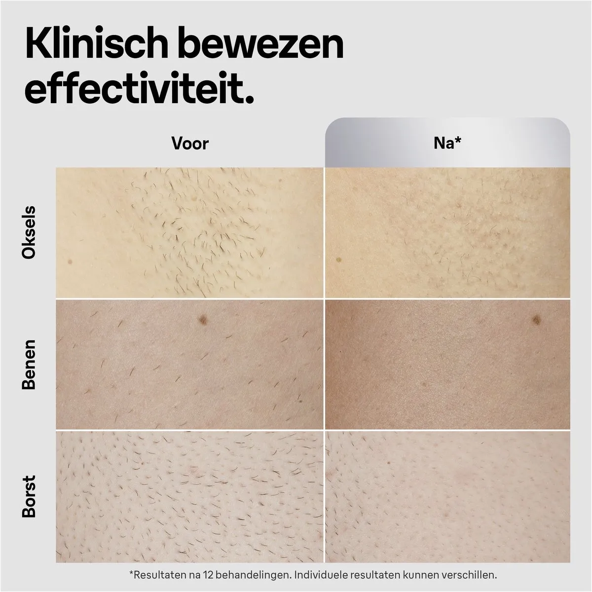 Braun IPL Silk-expert Pro 5 PL5145 Ontharingsapparaat - 400.000 Flitsen - Wit