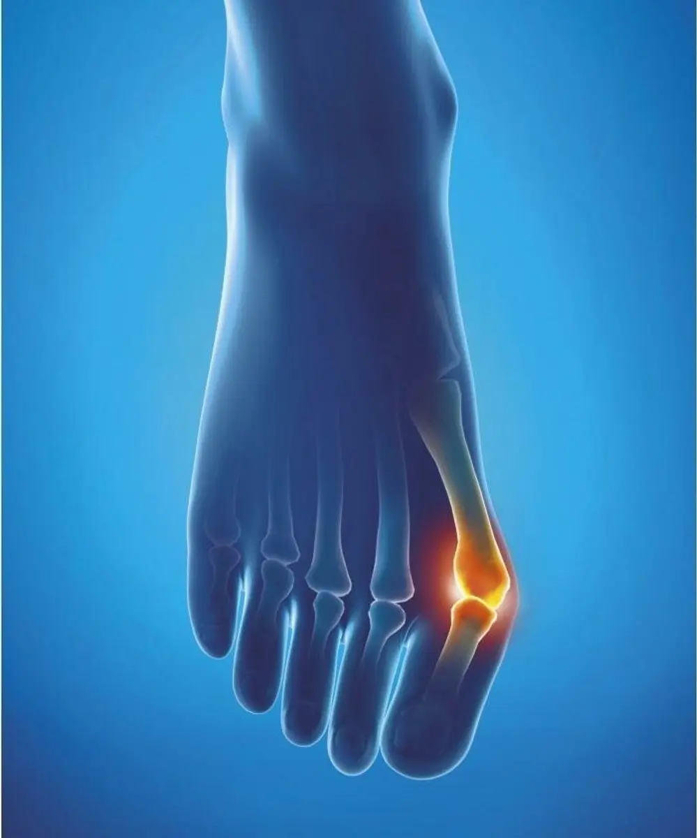 Epitact Hallux Valgus Teen Spreiders - 2 Stuks