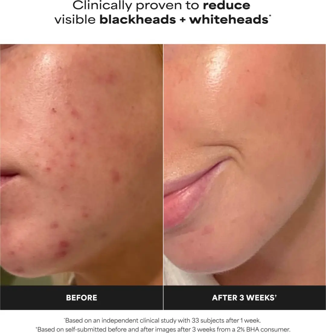 Paula's Choice Skin Perfecting 2% BHA Liquid Exfoliant 236ml