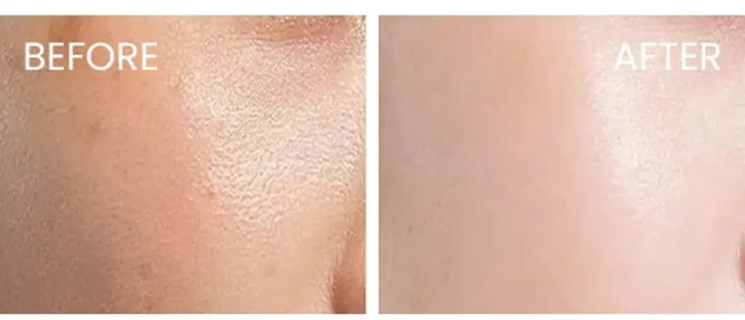 BIRETIX Focus Gel Blemish Reducer 15ml