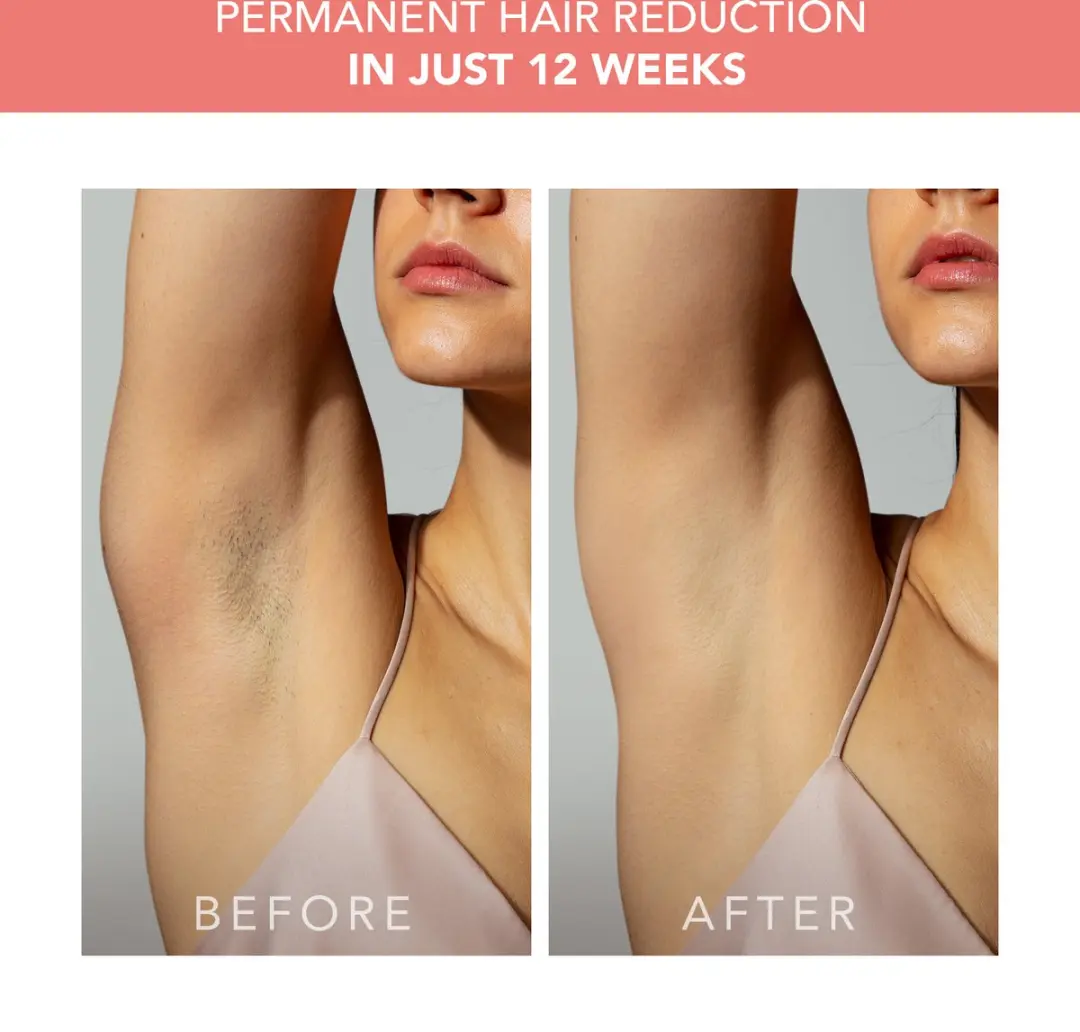 FOREO PEACH 2 IPL Ontharingsapparaat - Peach