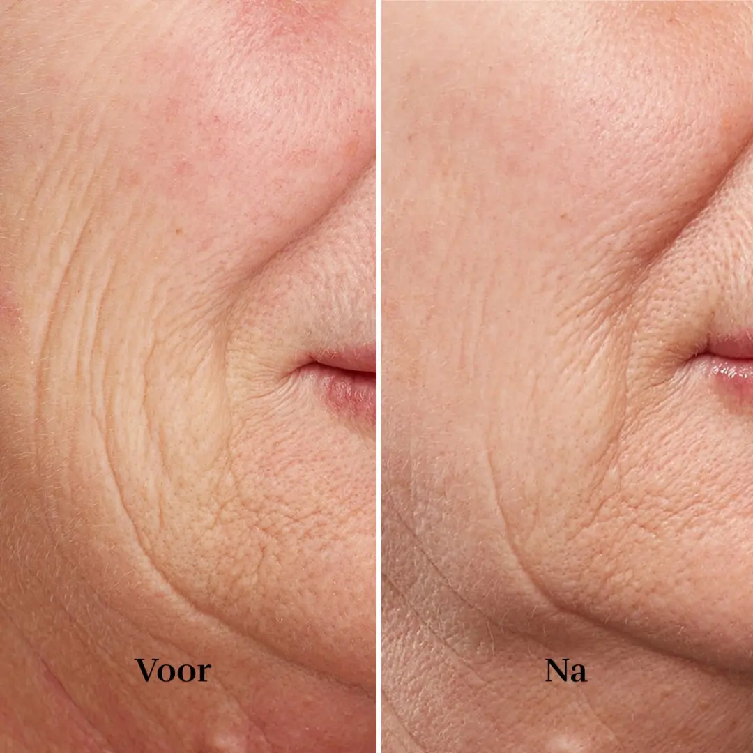 Silk'n FaceTite Revive Huidverjongingsapparaat - Gezicht - Wit