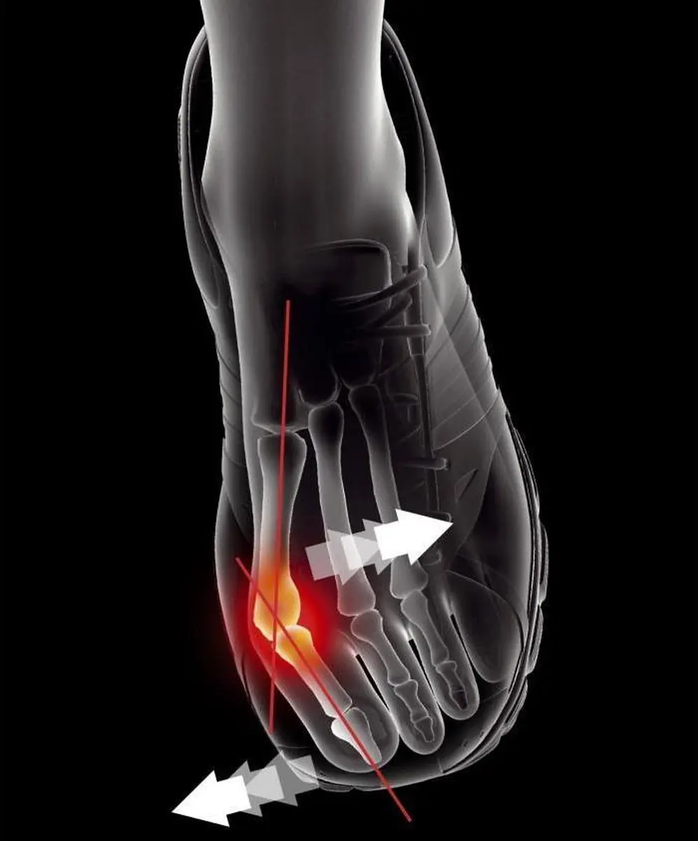 Epitact Sport Hallux Valgus Brace S - Zwart