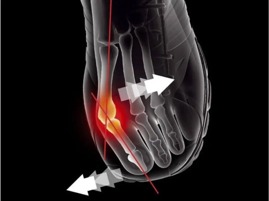 Epitact Sport Hallux Valgus Orthese Maat M