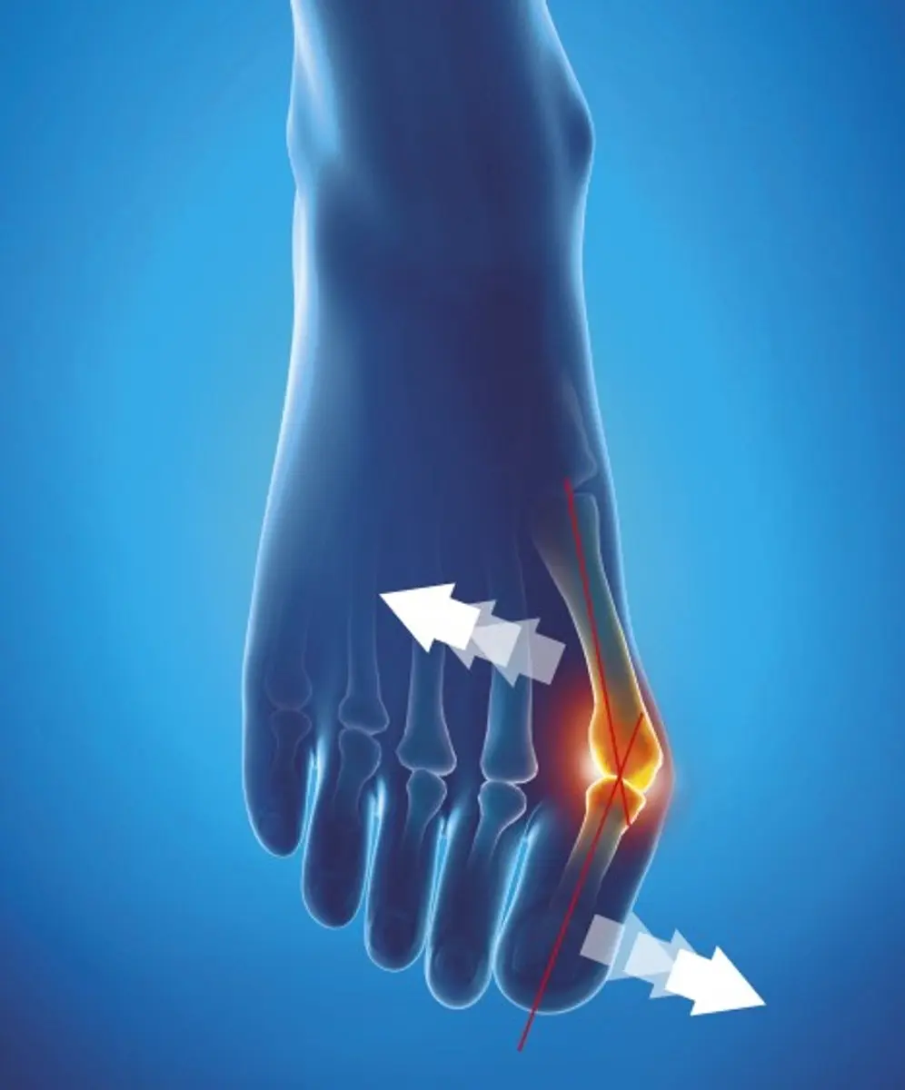 Epitact Hallux Valgus Orthese 39/41 - Huidskleur